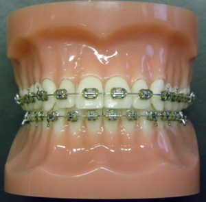 Types-of-Braces-1