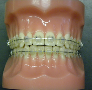 Types-of-Braces-2